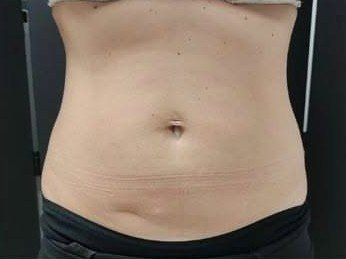 البطن بعد ١٠ جلسات Cryo Slim Body