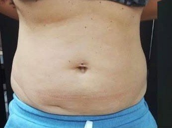 البطن قبل جلسات Cryo Slim Body